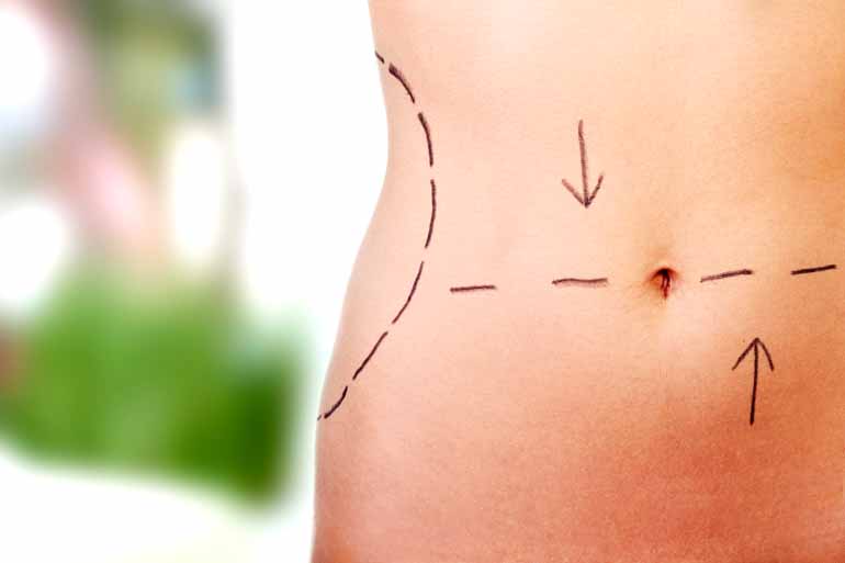 Shutterstock - Procedimentos mais procurados pelas mulheres são a lipoaspiração e a prótese de mama Shutterstock - Procedimentos mais procurados pelas mulheres são a lipoaspiração e a prótese de mama