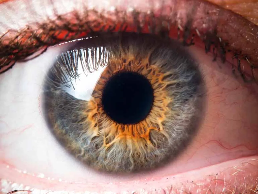A íris controla a quantidade de luz que entra no olho, e as pessoas com  defeitos nela têm grande sensibilidade à luz e outros problemas de visão graves
