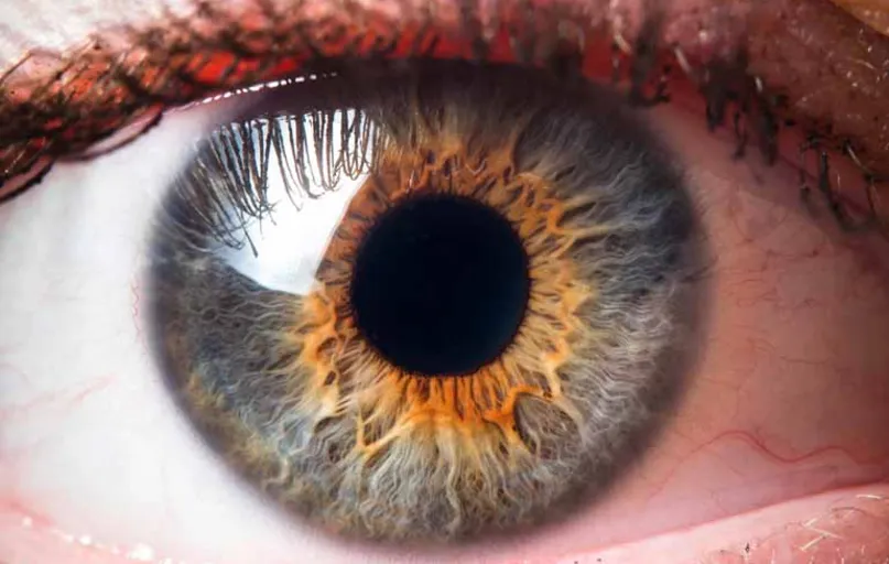 A íris controla a quantidade de luz que entra no olho, e as pessoas com  defeitos nela têm grande sensibilidade à luz e outros problemas de visão graves