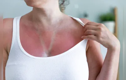 Imagem ilustrativa da imagem Exposição ao calor agrava problemas de pele
