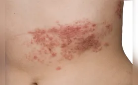Herpes-zóster também pode afetar adultos jovens