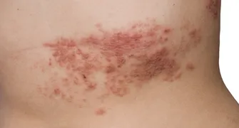 Herpes-zóster também pode afetar adultos jovens