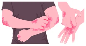 Dermatite atópica impacta pele, sono, saúde mental e autoestima