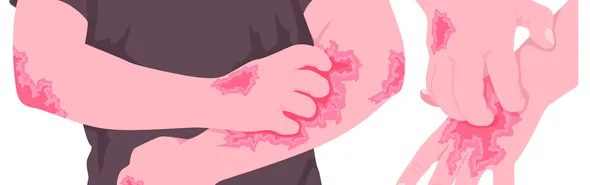 Imagem ilustrativa da imagem Dermatite atópica impacta pele, sono, saúde mental e autoestima