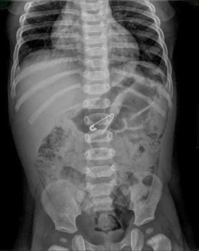 Segundo gastroenterologista, a ingestão de corpos estranhos é mais frequente em crianças menores de cinco anos 