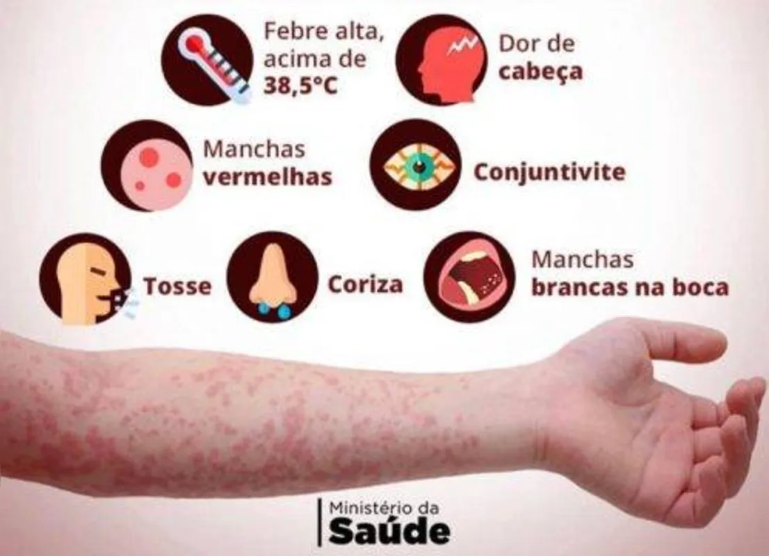Imagem ilustrativa da imagem UFPR tem 17 casos confirmados de sarampo e 43 suspeitos