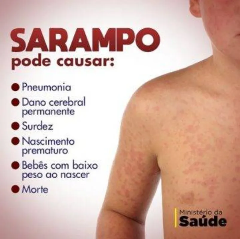 Imagem ilustrativa da imagem UFPR tem 17 casos confirmados de sarampo e 43 suspeitos