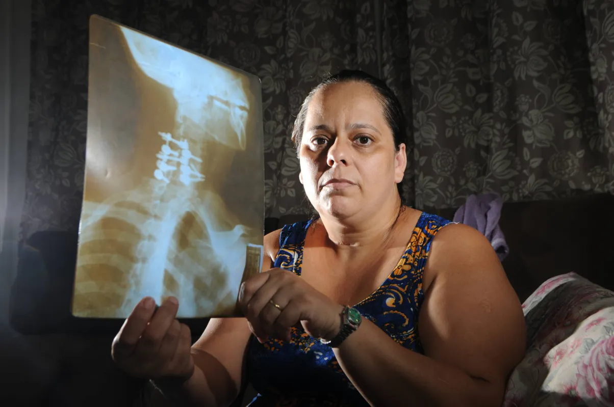 Para Rosimara Rodrigues de Paula Marconato, cirurgia trouxe esperança de redução de efeitos colaterais pelo uso de medicamentos para dor crônica