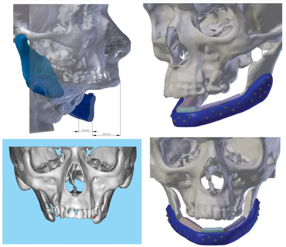 Imagem ilustrativa da imagem Cirurgia para reconstrução de mandíbula em Londrina dura 15 horas