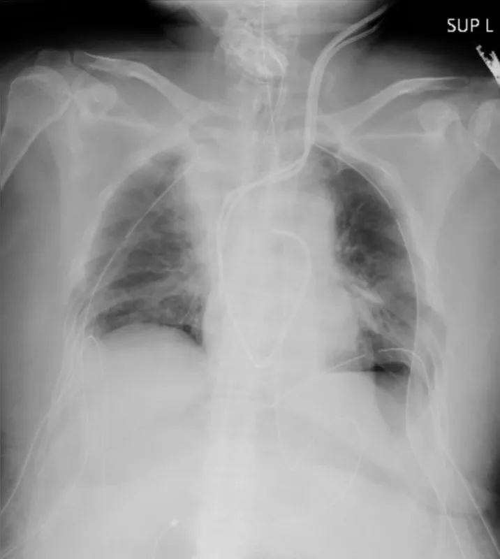 Imagem ilustrativa da imagem Almanaque M@is –  o primeiro transplante de pulmão a paciente de Covid-19 com doadores vivos