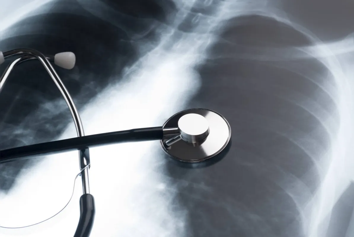 Imagem ilustrativa da imagem Entenda o câncer no pulmão que a cantora Rita Lee está tratando