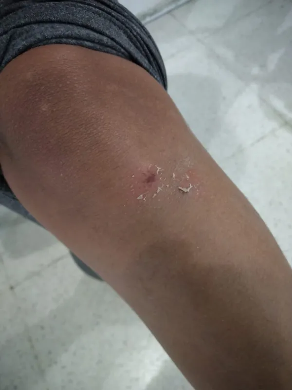 Dayane Padilha também sofreu escoriações na perna
