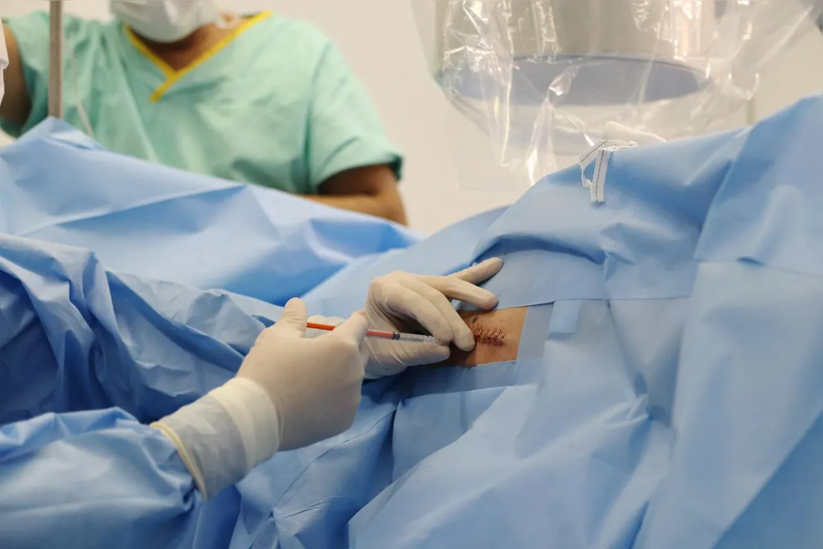 A aplicação da polilaminina é intramedular, com o neurocirugião misturando a laminina com o diluente logo antes para formar o complexo